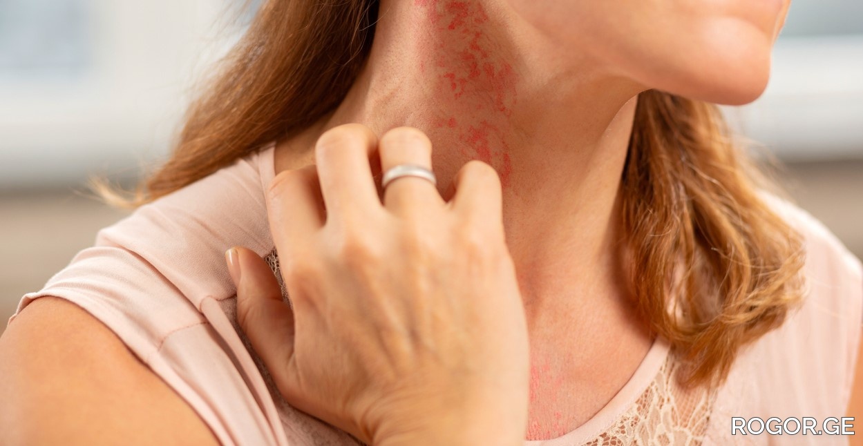 როგორ ვებრძოლოთ მზის ალერგიას rogor.ge